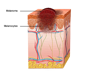 Picture showing melanoma in the skin